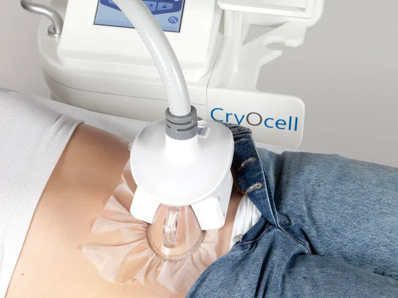 Pièce à main du CryOcell posée sur l'abdomen, avec sa membrane de protection à usage unique, lors d'une séance de cryolipolyse à Vannes