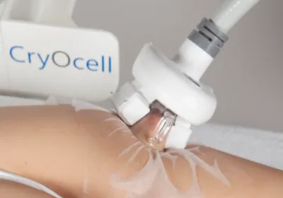 Applicateur CryOcell en position sur une zone du corps, lors d'une séance de cryolipolyse à Vannes